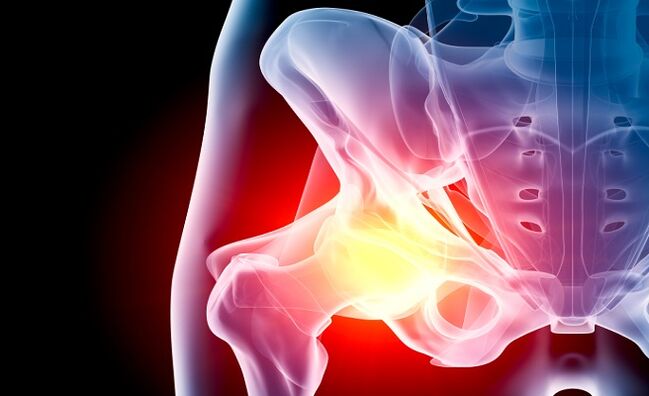 arthrosis នៃសន្លាក់ត្រគាក