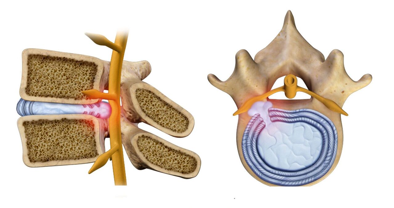 ក្លនឆ្អឹងខ្នងនៅក្នុង osteochondrosis thoracic