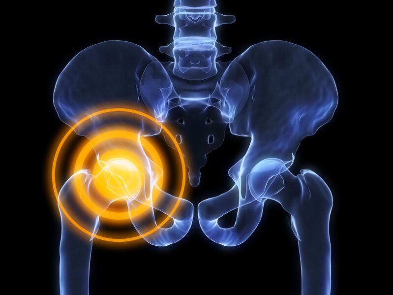 arthrosis នៃសន្លាក់ត្រគាក