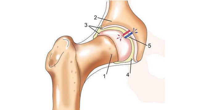 សន្លាក់ត្រគាកនិង arthrosis